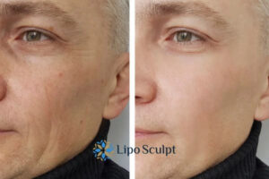 How to Fight Aging Symptoms 3 Fight Aging Symptoms Cheltenham With HIFU and Morpheus8 Today!