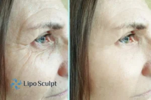 How to Fight Aging Symptoms 2 Do you want to Fight Aging Symptoms Cheltenham? Contact Lipo Sculpt today!
